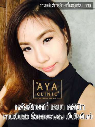 รักษาสิวหาายขาด