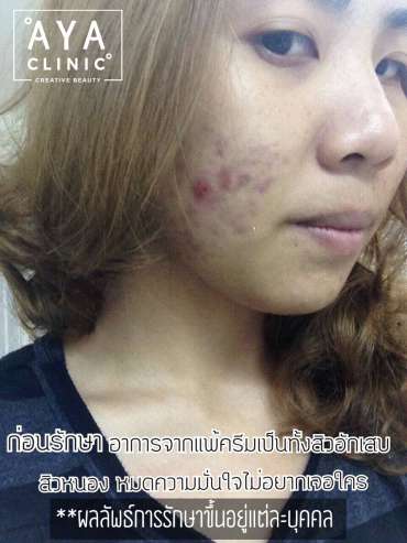 รักษาสิว