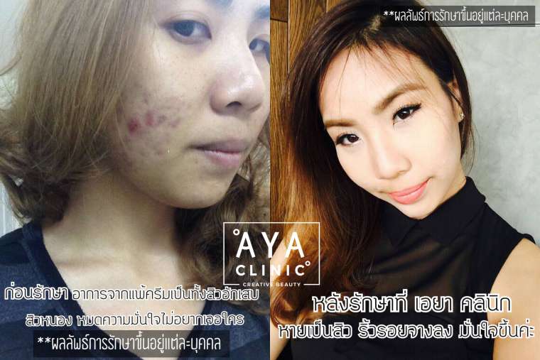 รักษาสิวอักเสบ