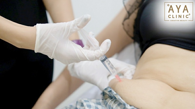 ฉีดเมโสแฟตราคา