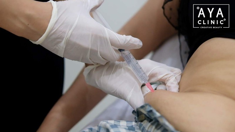 เมโสแฟตหน้าท้อง