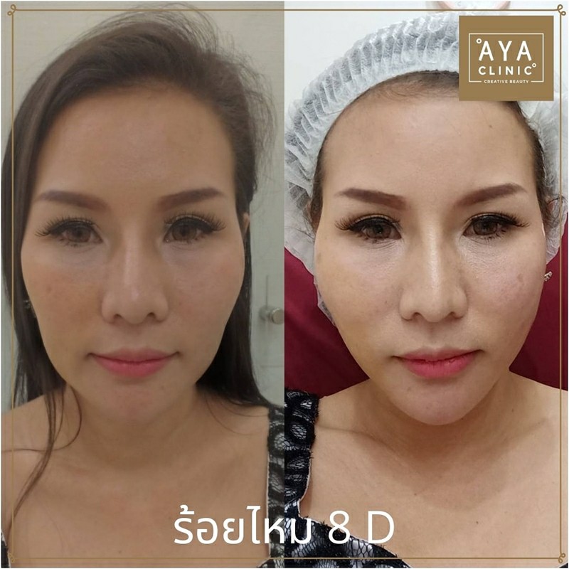 ดึงหน้าร้อยไหม