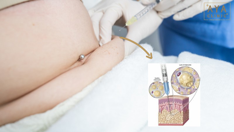 เมโสแฟตหน้าท้อง