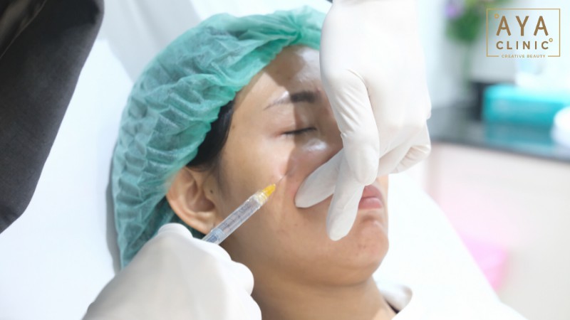 ฉีดฟิลเลอร์ใต้ตาราคา