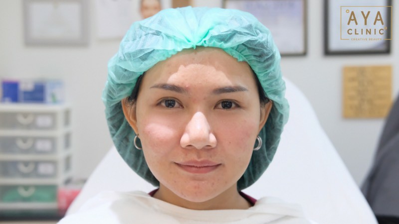 ฉีดฟิลเลอร์ใต้ตาราคา