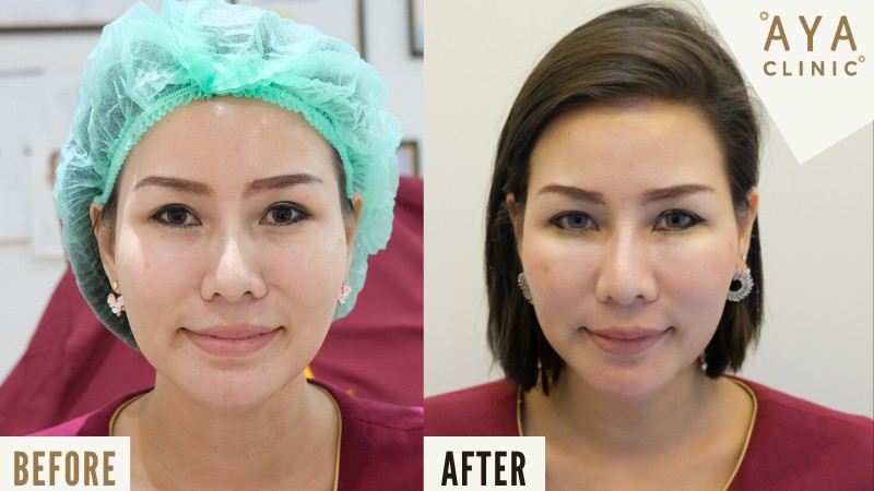 รีวิวฉีดฟิลเลอร์ใต้ตา