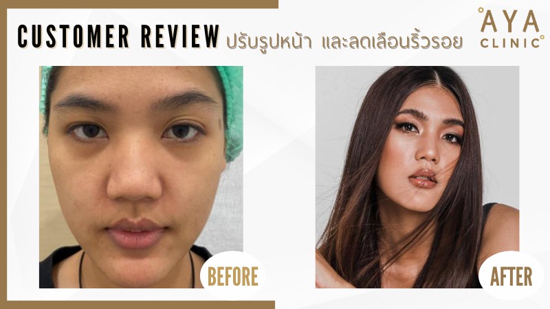 รีวิวฉีดโบท็อกซ์