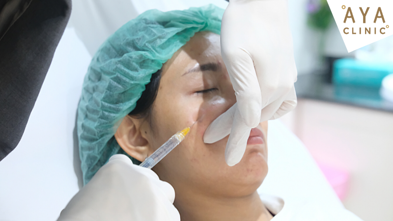 ฉีดฟิลเลอร์แก้มตอบ