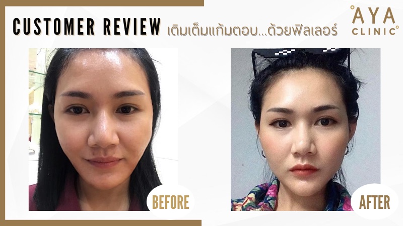 ฉีดฟิลเลอร์แก้มตอบ