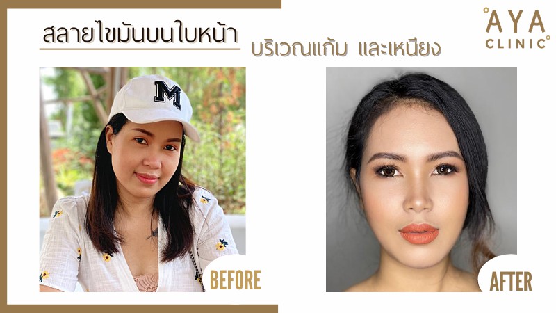 รีวิวฉีดแฟต