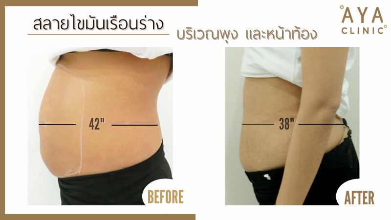 ฉีดเมโสแฟตราคา