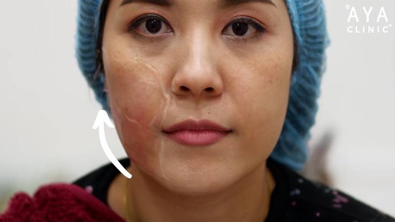 hifu ที่ไหนดี