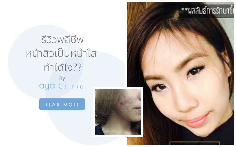 รีวิวรักษาสิว