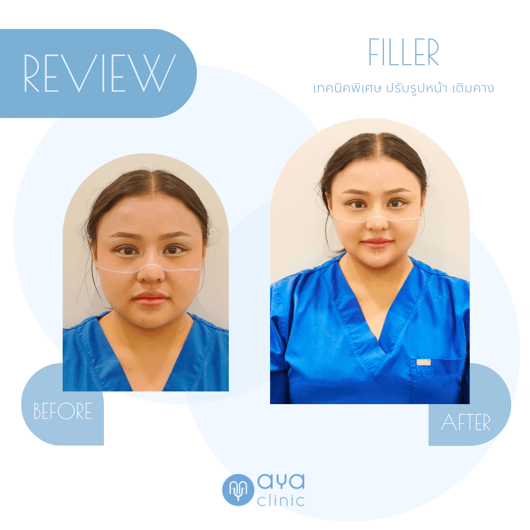 เติมคาง ด้วยFiller