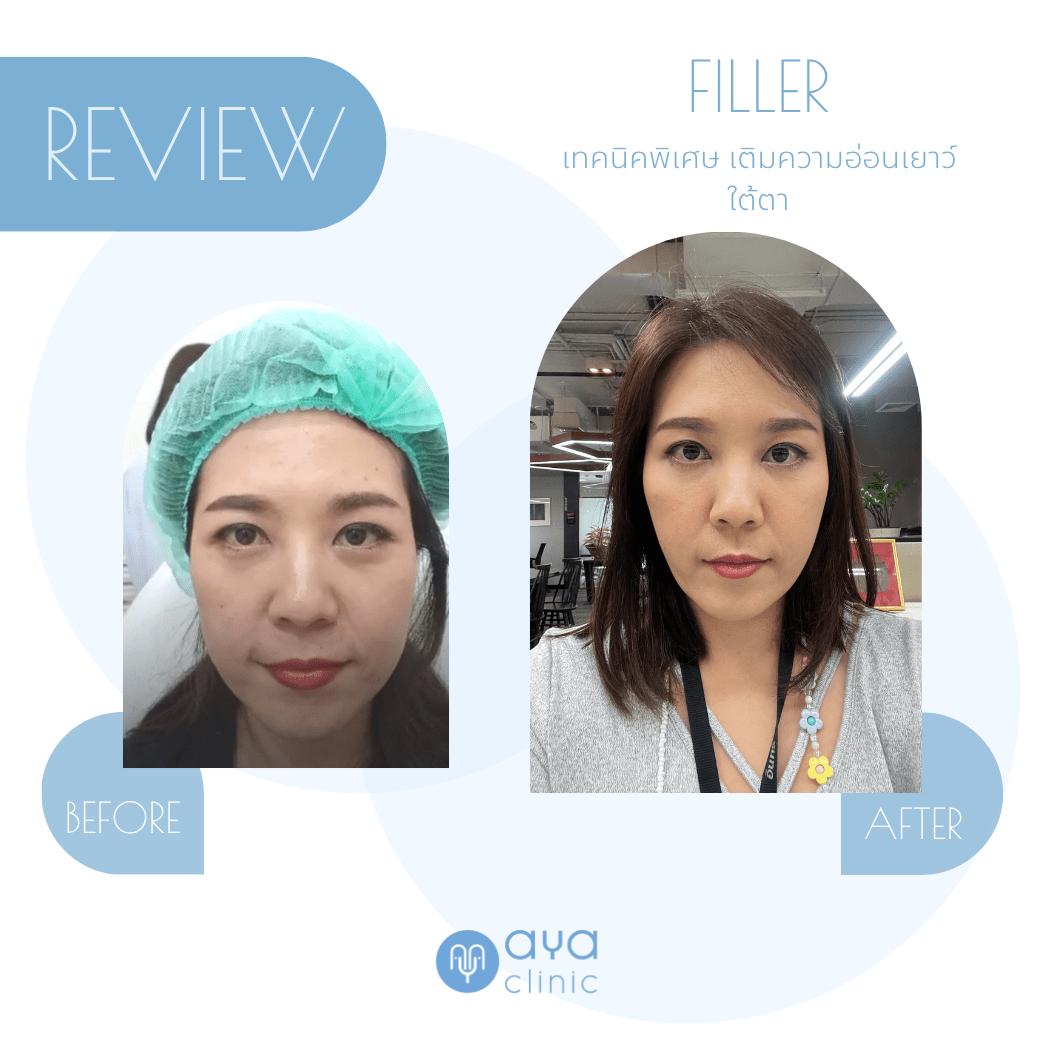 Filler เติมเต็มใต้ตา