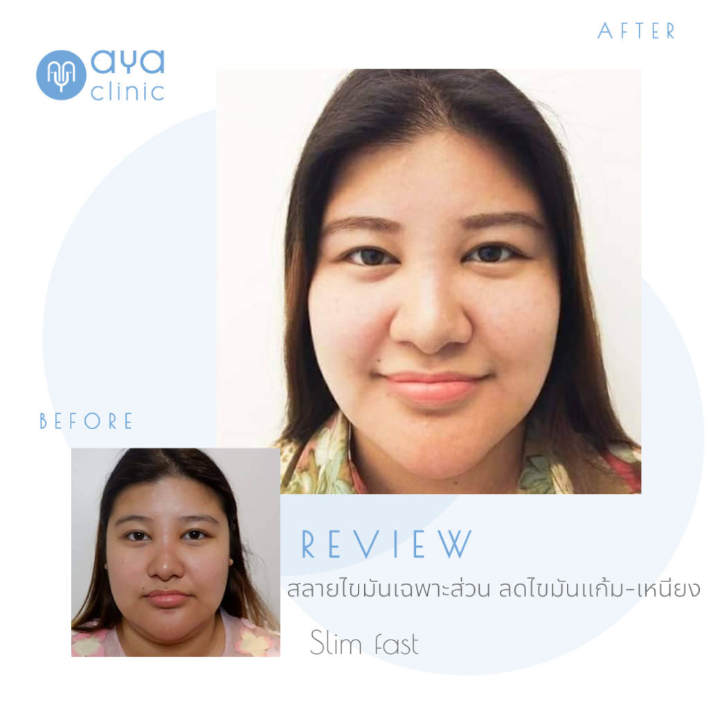 Makeover รีวิวสลายไขมัน Slimfast