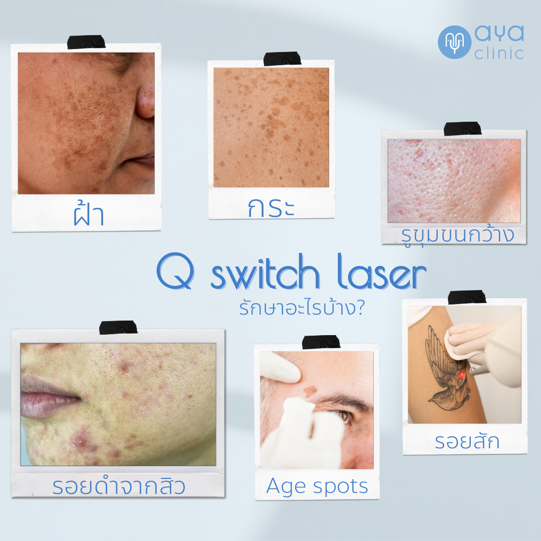 Q-switch laser เหมาะสำหรับใคร