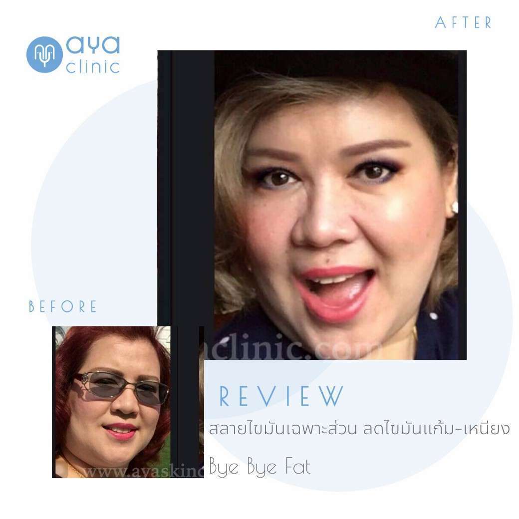 เมโสแฟต