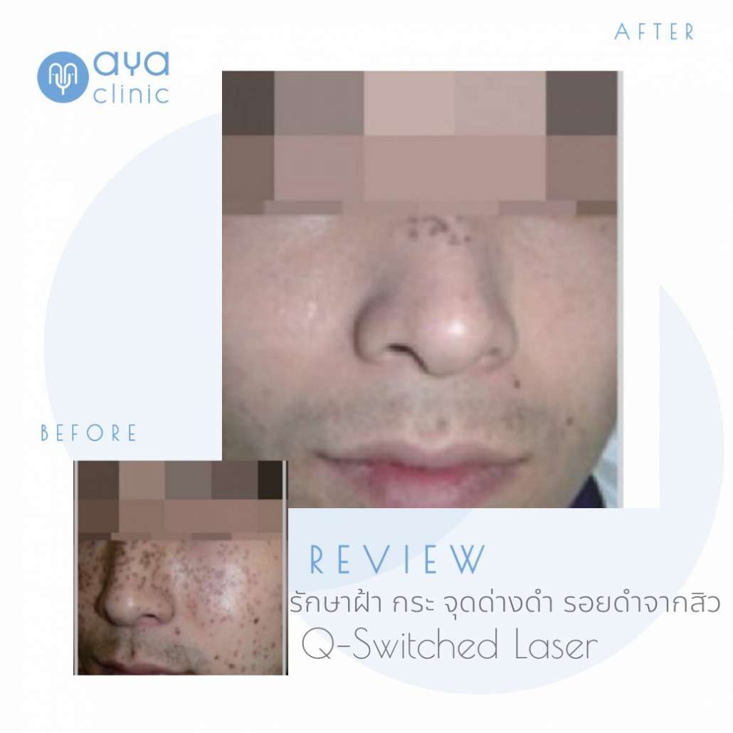 laserผู้ชาย