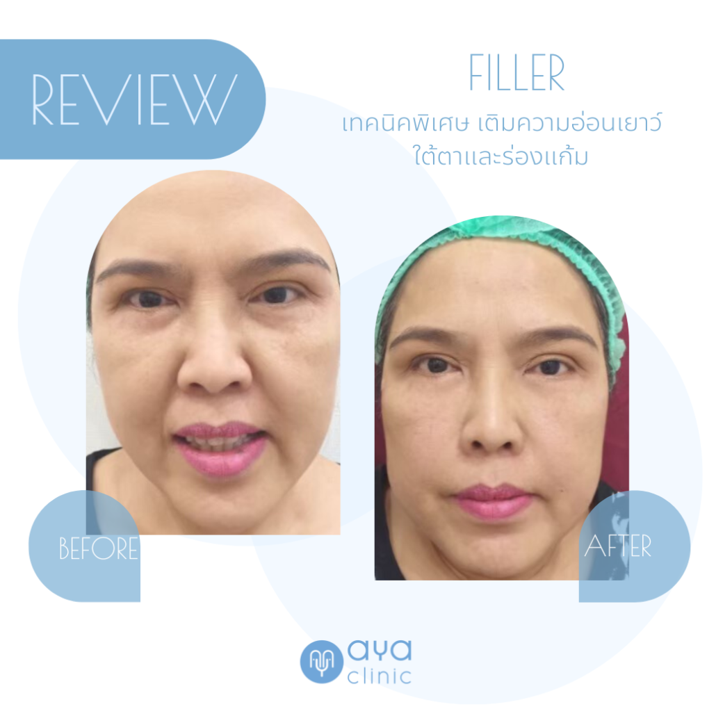 ฉีดฟิลเลอร์ใต้ตา 