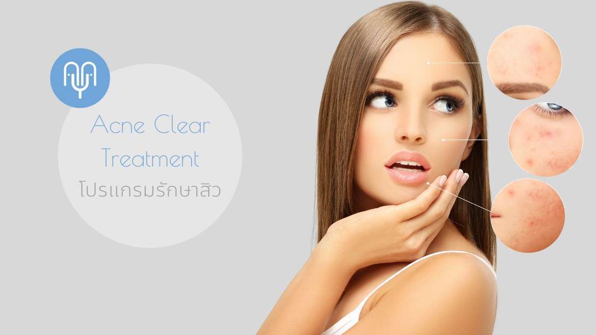 Free Acne with ACNE Clear Treatment Acne Clear Treatment