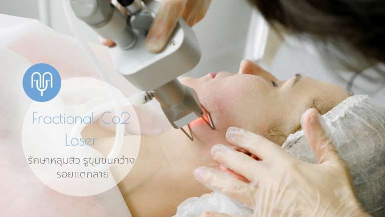 รักษาหลุมสิว