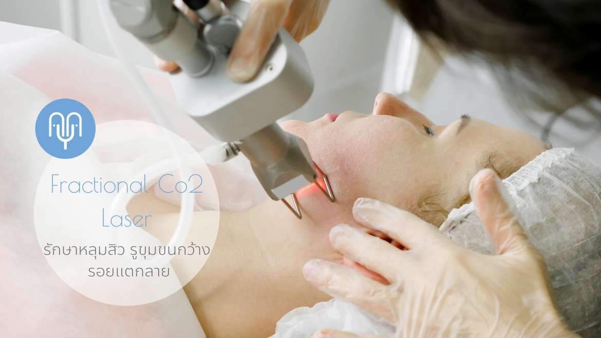Treat Acne Scars and Wide Pores with Fractional C02 Laser