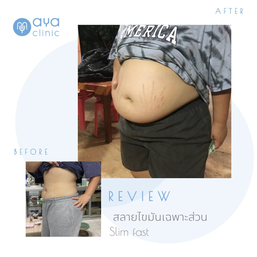 รีวิว Slimfast สลายไขมันเฉพาะส่วน