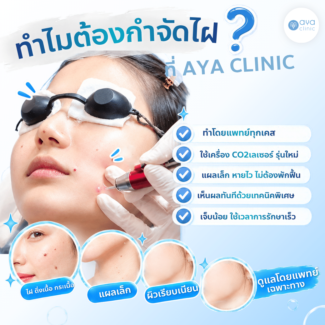 กำจัดไฝ
