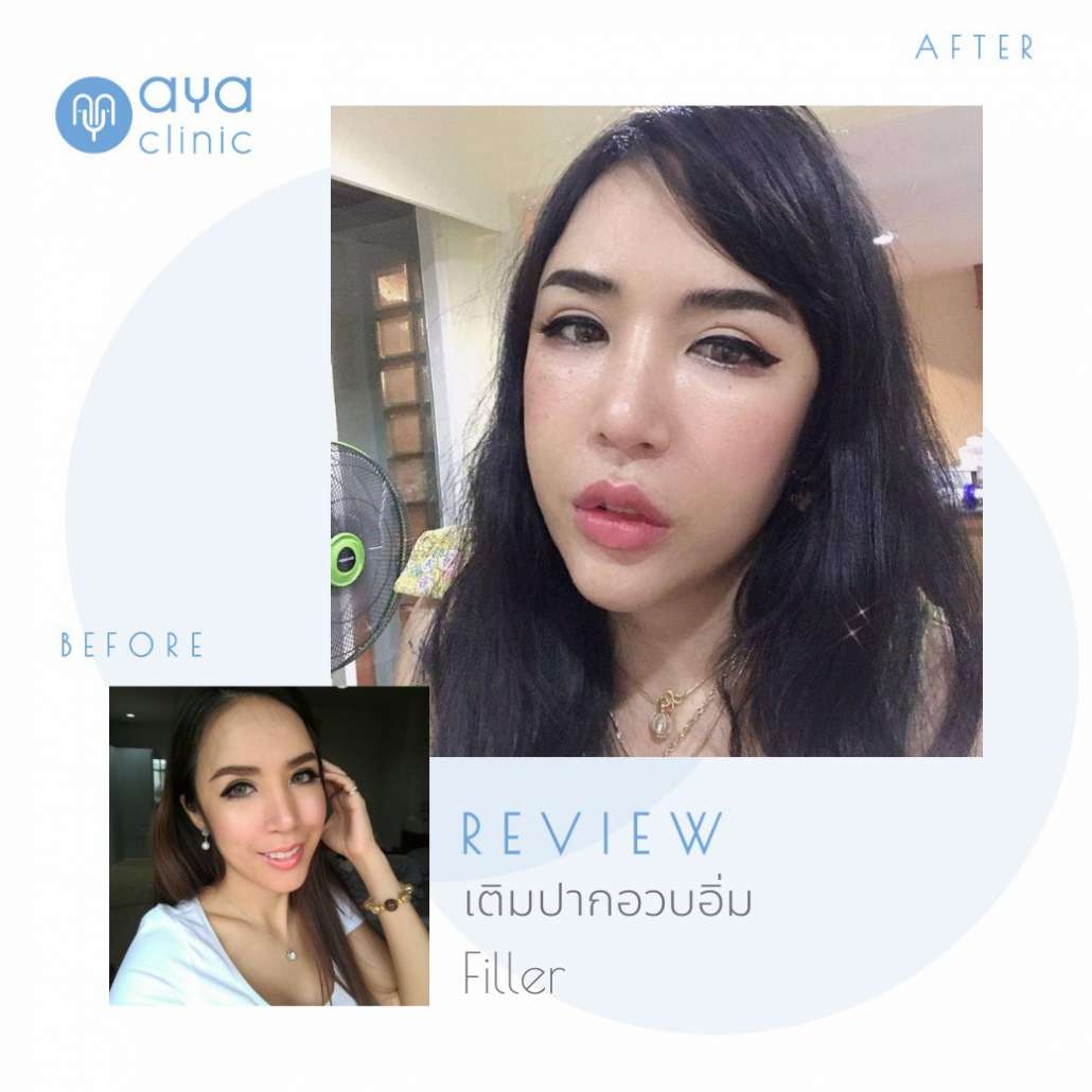 ฟิลเลอร์ปาก