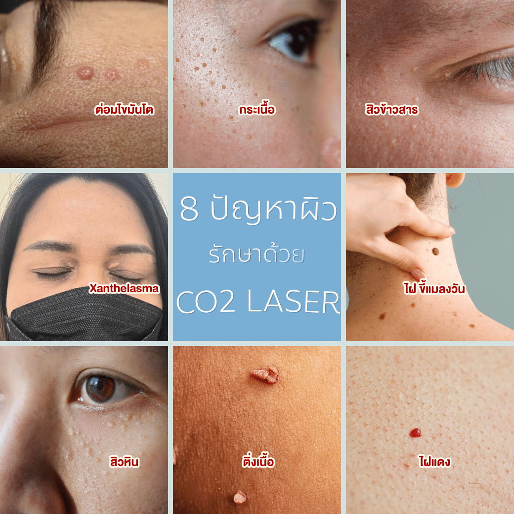 Co2 Laser