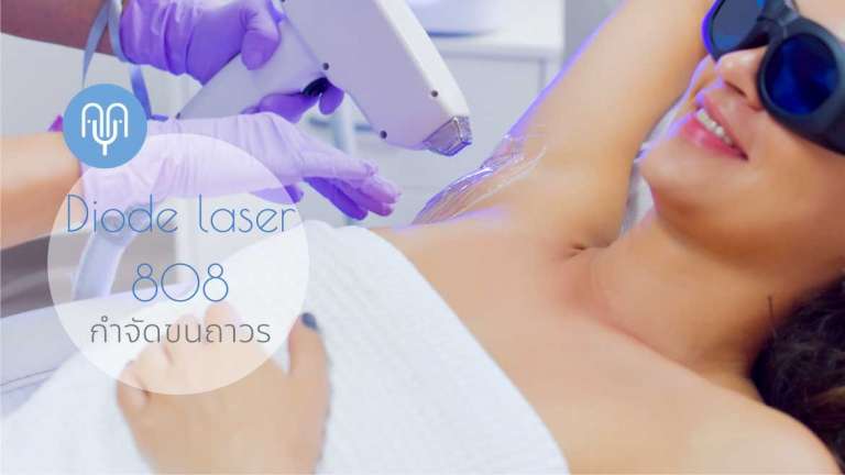 Diode laser กำจัดขนแบบถาวร