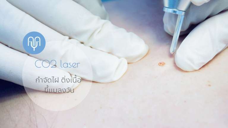 co2 laser กำจัดไฝ