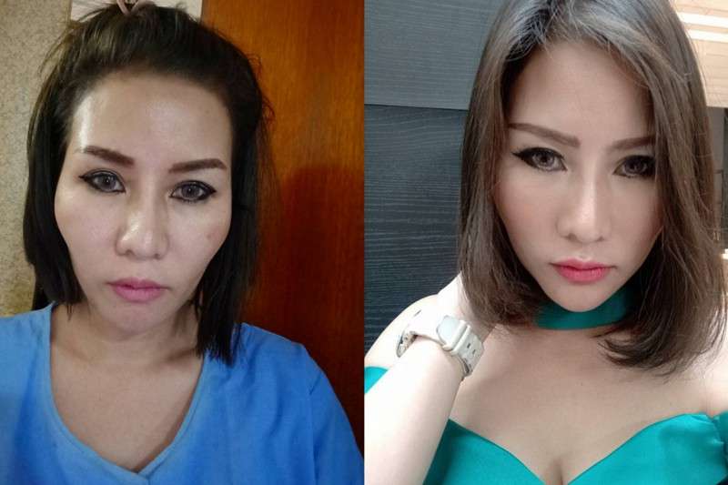 ฉีดฟิลเลอร์แก้มตอบ