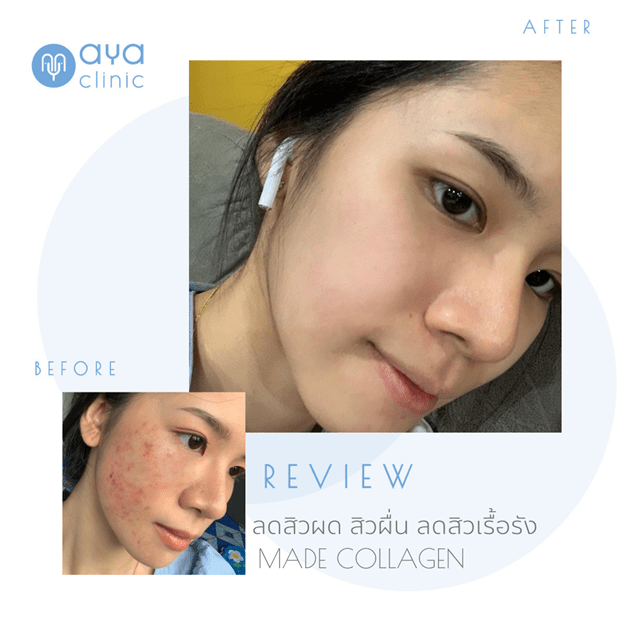 การฉีดเมโสหน้าใสเพื่อลดสิวผด