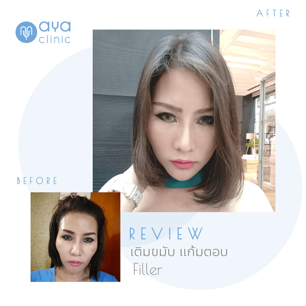 ฉีดเพิ่มแก้มที่ไหน