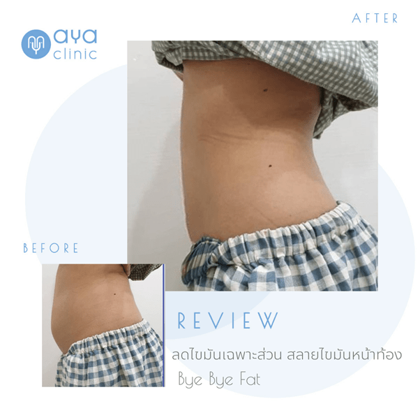 สลายไขมันเฉพาะส่วน