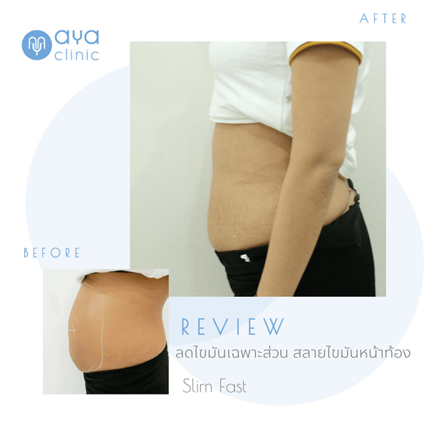 รีวิวการสลายไขมันเฉพาะส่วน