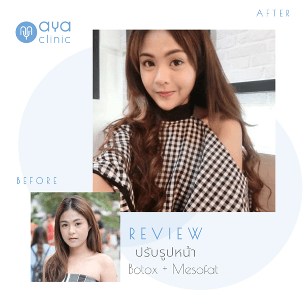 ผลลัพธ์ของโบท็อกซ์