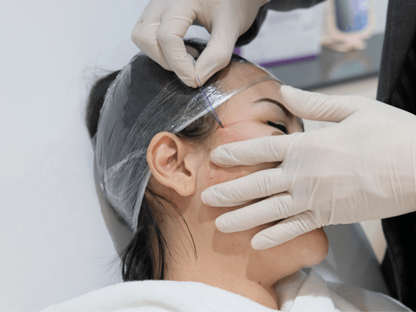 ร้อยไหมปรับรูปหน้า