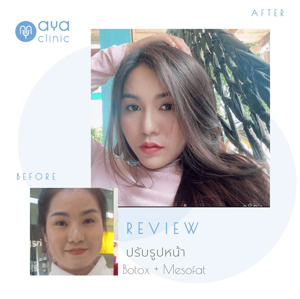 ฉีดโบท็อก