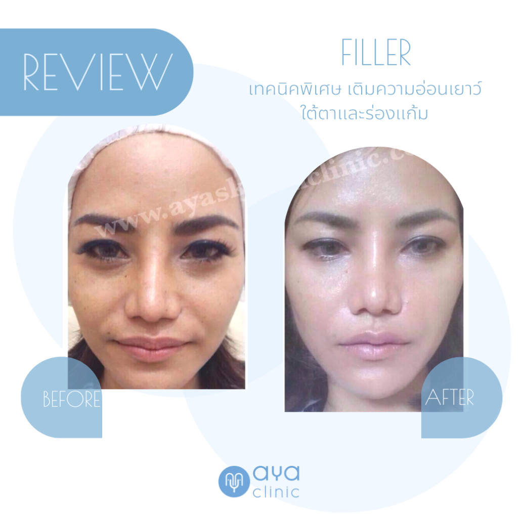 เติมฟิลเลอร์ใต้ตาร่องแก้ม