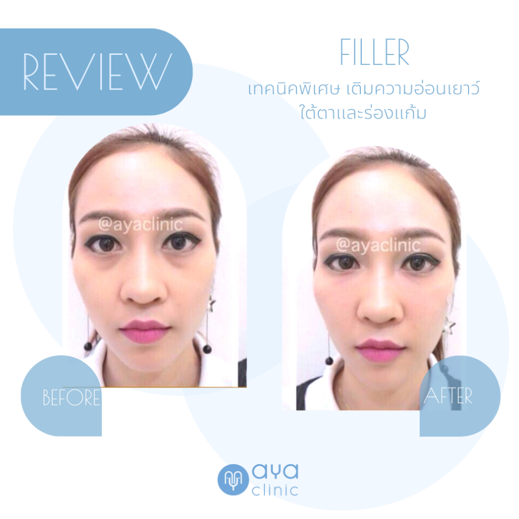 เติมเต็มใต้ตาด้วย Filler