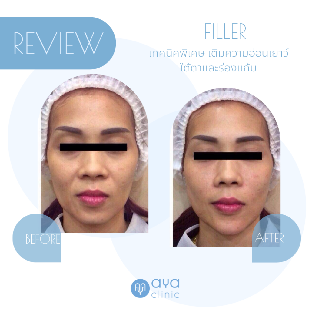 ฟิลเลอร์ใต้ตา