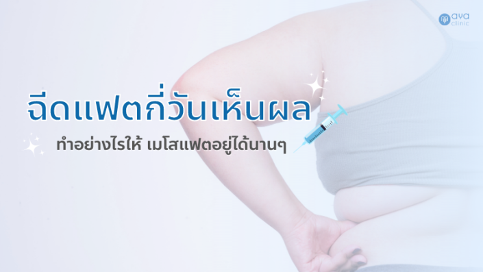 ไขมันส่วนเกินบนใบหน้าบางจุดไม่ว่าจะเป็นเหนียงใต้คาง แก้ม ต้นขาหรือต้นแขน ที่ออกกำลังกายเท่าไรก็ไม่สวยได้สัดส่วนสักที เหนื่อยไม่เท่าไร แต่เหนื่อยแล้วไม่ได้ผลอาการท้อก็ตามมา การมีตัวช่วยอย่าง เมโสแฟตสำหรับความสวยเป๊ะของใบหน้า หรือส่วนต่าง ๆ ของร่างกายที่มีไขมันนั้น สามารถปรับให้ได้สัดส่วน ในระยะเวลาที่เราสามารถกำหนดได้ หลังจากนั้นถ้าเรามีเทคนิคหลังจากฉีดเมโสแฟตเพื่อรักษาความสวยให้อยู่กับเราได้นาน ก็จะทำให้ปัญหาความสวยที่เรากังวลหมดไป เมโสแฟต (Meso Fat) คืออะไร สำหรับเมโสแฟตนั้นเป็นการฉีดสลายไขมันในบริเวณหรือจุดที่เราต้องการปรับสัดส่วนให้เล็กลง ด้วยการนำไขมันในบริเวณนั้นออก ซึ่งเป็นการหัตการที่แพทย์จะช่วยฉีดเมโสแฟตให้เกิดการกระตุ้นในการทำงานของระบบสลายไขมันของร่างกาย ซึ่งไขมันนั้นจะแตกตัวและสลายออกไปทางระบบขับถ่ายไม่ว่าจะเหงื่อ ปัสสาวะหรืออุจจาระ การฉีดแฟตนั้นจะทำให้รูปหน้ากระชับได้สัดส่วน โดยไม่ต้องผ่าตัด เห็นผลได้ชัดเจนหลังจากจากฉีด เมโสแฟตแล้ว และถ้ามีการดูแลที่ถูกต้อง รูปหน้าหรือสัดส่วนที่เราต้องการนั้นก็จะอยู่กับเราได้นาน การฉีดเมโสแฟตนั้นเป็นนวัตกรรมสลายไขมันที่จะประกอบไปด้วยยา 4 ประเภทหลัก ได้แก่ Mesostabyl มีหน้าที่ในการทำไม่ให้เกิดไขมันคลอเรสตอรอลในบริเวณชั้นเนื้อเยื่อตามส่วนต่าง ๆ ของร่างกาย L-carnitine มีส่วนช่วยในการสลายไขมันตามจุดต่าง ๆ ที่เราได้ฉีดแฟตเข้าไปให้เปลี่ยนมาเป็นพลังงาน Tyrosine นั้นจะมีส่วนที่จะช่วยเร่งระบบเผาพลาญไขมันในร่างกายให้ทำหน้าที่ได้ดียิ่งขึ้น Artichoke extract เป็นส่วนสำคัญในการลดการสร้างกรดไขมัน Artichoke extract จะทำให้เกิดการสลายไขมันเฉพาะจุด ตัวยาที่ได้พูดถึงนี้จะเป็นส่วนที่ทำให้การฉีดเมโสแฟตแล้ว ยังมีตัวยาที่เป็นสารสกัดจากธรรมชาติไม่ว่าจะเป็นสารสกัดจากถั่วเหลือง ไข่แดงหรือวิตามินต่าง ๆ นั้น ซึ่งจะอยู่ในกลุ่มของ Phosphatidylcholine, Deoxycholate, Dexpanthenol, L-carnitine, Amino acid หรือ Minerals เมื่อแพทย์ทำการฉีดสารเหล่านี้เข้าไปในผิวหนัง โดยจะฉีดให้ลึกไปถึงชั้นไขมัน ด้วยตัวยาเป็นสารสกัดจากธรรมชาติ ร่างกายก็จะขับออกมาด้วยระบบขับถ่ายตามปกติได้ ฉีดแฟตกี่วันเห็นผล ? เมื่อฉีดเมโสแฟตแล้วผลที่เกิดขึ้นก็คือไขมันในบริเวณที่ถูกกระตุ้นนั้นจะเริ่มสลายตัวประมาณ 20 - 30% ของไขมันตั้งต้น เราจะเริ่มเห็นผลที่ชัดเจนขึ้นหลังจากการฉีดสลายไขมันประมาณ 1 อาทิตย์ ถ้าบริเวณที่ฉีดแฟตนั้นมีการสะสมไขมันเป็นจำนวนมาก อาจจะต้องมาฉีดซ้ำ โดยแพทย์จะแนะนำให้ฉีดห่างกัน 14 วัน การทำเมโสแฟตนั้น จะได้ผลและอยู่นาน กับผู้ที่มีการควบคุมอาหารและออกกำลังกายเพื่อลดไขมันควบคู่กันไปด้วย จะทำให้เกิดการสะสมไขมันช้าลง แต่ถ้าหลังฉีดไม่ควบคุมอาหารเลย ไขมันก็จะกลับมาสะสมเร็วขึ้น สัดส่วนก็จะกลับมาบวมเหมือนเดิม เมโสแฟตฉีดบริเวณไหนได้บ้าง การฉีดโมเสแฟตนั้น ถือว่าเป็นการสลายไขมันในรูปแบบที่ไม่มีผลกระทบกับร่างกาย จึงสามารถฉีดแฟตเพื่อส่วนลดสัดส่วนในบริเวณต่าง ๆ ของร่างกายได้ทั้งหมด โดยเฉพาะที่นิยมกันมาก ก็คือเหนียงใต้คาง ซึ่งเมโสแฟตนั้น ถือเป็นการลดเฉพาะจุดอย่างเร่งด่วน ฉีดลดแก้ม สำหรับสาว ๆ บางคนที่มีเนื้อบริเวณแก้มเยอะ อยากจะมีรูปหน้าเรียว เพื่อให้หน้าได้สัดส่วนที่ชัดเจนมากขึ้นการฉีดแฟต จะทำให้เนื้อบริเวณแก้มเล็กลง กรอบหน้าเรียวได้รูป ฉีดลดเหนียง ปัญหาโลกแตกสำหรับสาว ๆ เป็นล้านคนกับเหนียงใต้คางที่ ลดแทบตายยังไง ก็ไม่หายไปสักที การใช้เมโสแฟตเพื่อสลายไขมันเฉพาะจุดจะทำให้ปัญหานี้จบปิ๊งไปได้ ฉีดสลายไขมันหน้าท้อง อีกหนึ่งจุดที่ลดยากมาก ยิ่งเป็นสาวออฟฟิศที่ต้องนั่งทำงานกับโต๊ะทั้งวัน การลดไขมันหน้าท้องยิ่งทำให้ยากกันไปใหญ่ การมีตัวช่วยเพื่อฉีดสลายไขมัน ให้หน้าท้องแบนเรียบ แต่งตัวได้มั่นใจมากขึ้น ฉีดสลายไขมันต้นแขน และต้นขา เป็นส่วนที่ทำให้ผู้หญิงเกิดความไม่มั่นใจในการใส่เสื้อผ้าเป็นอย่างมาก ต้นแขนใหญ่ก็ไม่กล้าใส่เสื้อแขนกุด ขาใหญ่ก็ไม่กล้าใส่กระโปรงสั้น การฉีดสลายไขมันเฉพาะจุดจะทำให้ความมั่นใจในสัดส่วนที่ดูดีขึ้นกลับมา ผลลัพธ์ของการฉีดเมโสแฟตเห็นผลช้าหรือเร็ว แตกต่างกันอย่างไร ความแตกต่างกันระหว่างบุคคลที่ได้รับการฉีดแฟตนั้น ขึ้นอยู่กับปริมาณการสะสมไขมันของแต่ละคน ที่เราถือว่าเป็นไขมันตั้งต้นนั้นมีมากน้อยแค่ไหน ถ้ามีปริมาณไขมันสะสมอยู่มาก การลดไขมันหลังจากฉีดเมโสแฟตแล้วจะลดไปประมาณ 20 - 30% ถ้ายังมีไขมันเหลืออยู่เยอะ ก็จำเป็นจะต้องมาฉีดซ้ำ ซึ่งควรจะเว้นไปประมาณ 7 - 10 วัน นอกจากนั้นผลของการเมโสแฟตยังอยู่กับการดูแลตัวเองหลังฉีด ซึ่งแนะนำให้ควบคุมอาหารและออกกำลังกาย เพื่อไม่ให้ไขมันกลับมาสะสมเร็วเกินไป ถ้ามีการดูแลตัวเองหลังจากการฉีดที่ดีพอแล้ว สัดส่วนที่ได้รับการฉีดเพื่อสลายไขมันนั้นจะอยู่กับเราไปนานถึง 3 เดือน สำหรับผู้ที่เหมาะกับการฉีดแฟตนั้น จะเป็นสาว ๆ ที่ต้องการเห็นผลชัดเจนภายใน 5 - 7 วัน โดยเฉพาะบริเวณที่ต้องการลดเฉพาะจุดอย่างแก้ม เหนียง คาง ต้นขา ต้นแขน สำหรับผู้ที่ควรระวังหรือห้ามในการฉีดแฟตนั้น ได้แก่หญิงตั้งครรภ์ห้ามเด็ดขาด ส่วนผู้ที่รับยาเป็นปริมาณมาก อยากยาเบาหวาน ความดัน มะเร็ง ควรจะปรึกษาแพทย์ก่อน รวมถึงกลุ่มที่มีประวัติผิวหนังอักเสบได้ง่าย ก็ควรปรึกษาแพทย์ก่อนจะรับการฉีดเมโสแฟต หลังฉีดเมโสแฟตทำอย่างไรให้อยู่ได้นาน และเห็นผลเร็ว สำหรับการดูแลตัวเองหลังจากได้ฉีดเมโสแฟตไปแล้ว ควรรับฟังขั้นตอนการแนะนำจากแพทย์ ซึ่งถ้าเราทำตามอยากถูกต้อง ความสวยจะอยู่กับเราได้นานขึ้น อันดับแรกควรควบคุมอาหารให้รับประทานได้อย่างเหมาะสม ลดไขมันด้วยการลดอาหารที่มีไขมันในปริมาณมาก ไม่ว่าจะเป็นของทอด ไขมันจากสัตว์ เนื้อติดมัน ของหวาน โซเดียม ซึ่งล้วนแล้วแต่จะทำให้เกิดการสะสมของไขมันในร่างกายมากและรวดเร็ว แนะนำให้รับประทานอาหารที่มีประโยชน์มีปริมาณไขมันน้อย ไม่ว่าจะเป็นข้าวกล้อง เนื้อสัตว์ที่แนะนำก็พวกตระกูลปลา อกไก่ ผัก อาหารที่ปรุงน้อยเพื่อลดโซเดียมที่จะเข้าสู่ร่างกาย หรือใครจะดูแลเรื่องระยะเวลาในการรับประทานอาหาร เช่น ไม่รับประทานอาหารหลัง 17.00 น. ก็จะทำให้การเพิ่มไขมันในร่างกายน้อยลง การออกกำลังกายก็เป็นอีกสิ่งที่ควรปฏิบัติหลังจากฉีดแฟตแล้ว เรื่องออกกำลังกายแบบคาดิโอเพื่อส่วนสลายไขมันให้มากขึ้น อาจจะจัดเวลาวันละ 30 นาที หรือ ให้รวมกันแล้วได้ออกกำลังกายได้ 150 นาทีต่ออาทิตย์ ก็จะทำให้สัดส่วนที่เราทำการสลายไขมันไปอยู่กับเราได้นานขึ้น งดแอลกลอฮอล์รวมถึงการสูบบุหรี่ ซึ่งแอลกลอฮอล์นั้นมีส่วนให้ระบบการเผาพลาญของร่างกายแย่ลง ดังนั้นถ้าเรายังดื่มอยู่ การกลับมาของไขมันจะเร็วขึ้น ร่างกายจะกลับมาบวม ไม่สวยอย่างที่เราต้องการ การพักผ่อนให้เพียงพอ เพื่อให้ร่างกายได้เผาพลาญไขมันระหว่างที่เราหลับ การควบคุมน้ำหนักหรือลดน้ำหนักนั้น การพักผ่อนก็มีส่วนเป็นอย่างมาก ดังนั้นหลังจากเมโสแฟตแล้ว ถ้าอยากให้ผลลัพธ์ดี ก็ควรจะจัดสรรเวลาการนอนหลับให้เหมาะสมที่ 7 - 8 ชั่วโมงต่อวัน การดื่มน้ำอย่างน้อยวันละ 2 ลิตรเพื่อช่วยกระตุ้นการขับไขมันออกจากร่างกาย หลังจากที่เราฉีดเมโสแฟตเข้าไปแล้ว การกระตุ้นการสลายไขมันออกจากร่างกายด้วยระบบขับถ่ายจะทำงานได้ดียิ่งขึ้น ฉีดเมโสแฟตแล้วไม่เห็นผลเกิดจากอะไร สำหรับใครที่ทำเมโสแฟตแล้วไม่เห็นผลที่ต่างจากเดิม ยังมีไขมันเกาะอยู่ในบริเวณที่ฉีด สัดส่วนไม่กระชับ รูปหน้าไม่เรียว แก้วยังป่อง เหนียงยังมี ต้องลองดูจากสาเหตุ ดังนี้ ปริมาณของไขมันแต่บุคคลที่แตกต่างกัน ด้วยปริมาณไขมันที่สะสมของแต่ละคนที่ไม่เท่ากันทำให้การฉีดแฟตเพื่อเข้าไปกระตุ้นการสลายไขมันนั้น จะได้ผลที่แตกต่าง ใครที่มีไขมันสะสมอยู่มาก การฉีดเพียงครั้งเดียวอาจจะไม่เห็นผลชัดเจน ซึ่งจริง ๆ แล้วไม่เกี่ยวกับอ้วนหรือผอมด้วย ขึ้นอยู่กับไขมันของแต่ละคนที่มีในร่างกายเป็นหลัก ปริมาณการใช้ยาที่อาจจะไม่เหมาะสมกับไขมัน การเลือกใช้ยาสำหรับการฉีดแฟตนั้นก็ส่งผลที่แตกต่างด้วยเช่นกัน ซึ่งแพทย์ที่จะใช้ยาแต่ละประเภทให้เหมาะสมจะต้องเป็นผู้เชี่ยวชาญที่ศึกษาขั้นตอนมาแล้วเป็นอย่างดี ซึ่งการเลือกแพทย์ในการดูแลการทำเมโสแฟต จึงควรเลือกที่เป็นแพทย์เฉพาะทางที่น่าเชื่อถือ ความถี่ในการฉีดเมโสแฟตในแต่ละครั้ง ความถี่ของการฉีดเมโสแฟตนั้นก็มีส่วนต่อผลที่เราจะได้รับเช่นเดียวกัน ซึ่งถ้าเรามีไขมันที่สะสมอยู่มาก แล้วมีระยะเวลาในการเว้นฉีดแต่ละครั้งนานเกินไป ก็จะทำให้ปริมาณไขมันในบริเวณที่ฉีดถูกกำจัดออกไปไม่มากพอ ผลลัพธ์ที่เราอยากได้จึงไม่เป็นเป็นตามที่หวัง โดยจำนวนครั้งและความถี่ในการฉีดแฟตที่จะทำให้เห็นผลได้ชัดเจน ควรจะฉีด 2 - 10 ครั้ง มีระยะห่างแต่ละครั้งอยู่ที่ 7 - 10 วัน หากเราทิ้งระยะและไม่มีความต่อเนื่อง ผลของการสลายไขมันในจุดที่เราต้องการอาจจะไม่เกิดขึ้นหรือเกิดขึ้นน้อย คุณภาพของตัวยาที่ไม่ได้มาตราฐาน อันนี้ก็เป็นเรื่องที่สำคัญมาก ด้วยตัวยาที่อยู่ในตลาดนั้นมีหลากหลาย ต่างกันตามคุณภาพ ถ้าเราได้รับตัวยาที่คุณภาพต่ำกว่ามาตรฐาน ก็อาจจะไม่คุ้มเสีย ทำให้ไม่ได้สัดส่วน ความสวยที่ตั้งใจก็ไม่ได้เช่นเดียวกัน ข้อสรุป การฉีดแฟตนั้น เป็นกระชับสัดส่วนโดยใช้ระยะเวลาไม่นาน ไม่ต้องผ่าตัด ไม่มีผลกระทบต่อร่างกาย สามารถฉีดสลายไขมันได้เฉพาะจุด สำหรับใครที่อยากเห็นผลเร็ว หรือมีกำหนดการออกงานที่ชัดเจนว่าฉันต้องสวย เช่นงานแต่งงาน งานรับปริญญา การฉีดเมโสแฟตก็เป็นตัวช่วยที่ดี ซึ่งผลลัพธ์ที่ได้นั้นจะขึ้นอยู่กับปริมาณไขมันของแต่ละคน เราสามารถทำซ้ำในจำนวนความถี่และเว้นระยะห่างตามคำแนะนำของแพทย์ได้ เมื่อได้ผลลัพธ์ที่พอใจแล้ว ยิ่งถ้าเราดูแลตัวเองหลังฉีดได้ดีด้วยการควบคุมอาหาร ออกกำลังกาย พักผ่อนให้เพียงพอ งดแอลกลอฮอล์ สูบบุหรี่แล้วล่ะก็ ผลลัพธ์ที่ดีก็ยิ่งอยู่กับเราได้นาน เรียกได้ว่าสวยทันใจ ทันเวลาอย่างแน่นอน ฉีดแฟตกี่วันเห็นผล ทำอย่างไรให้อยู่ได้นาน