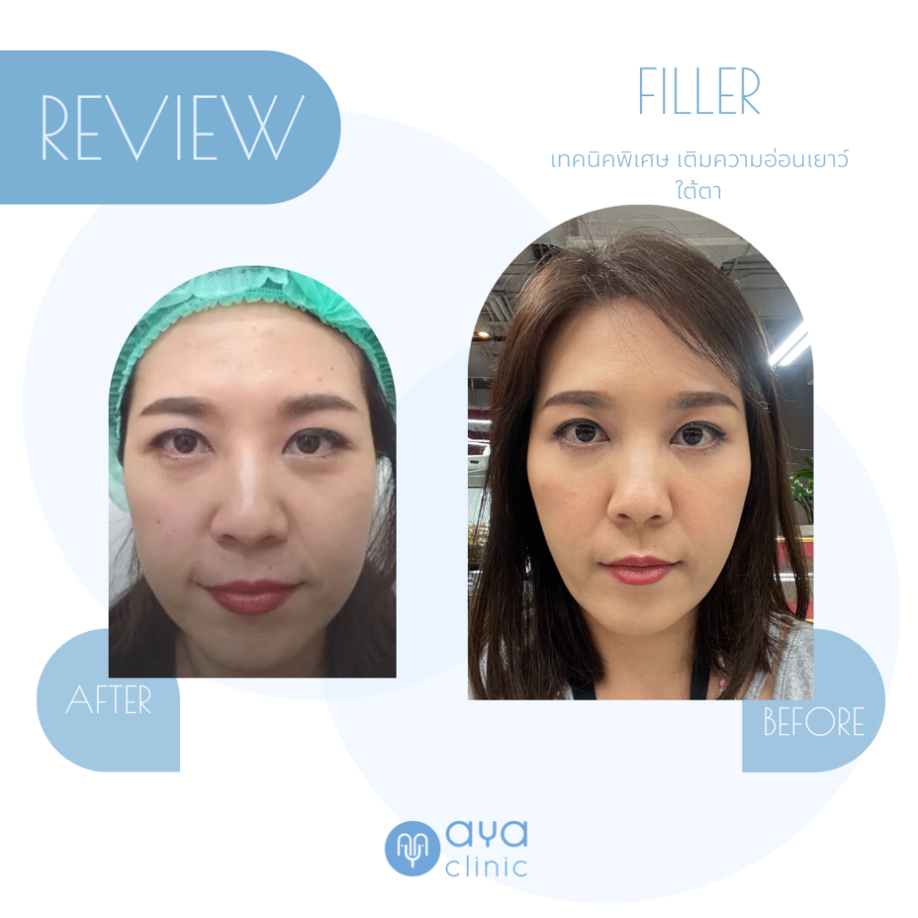 ฟิลเลอร์ใต้ตา