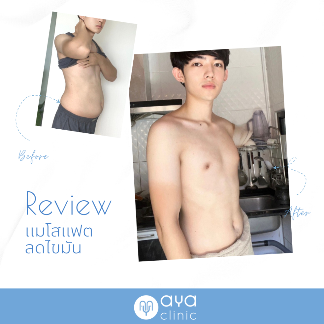 รีวิวเมโสแฟตลดหน้าท้อง