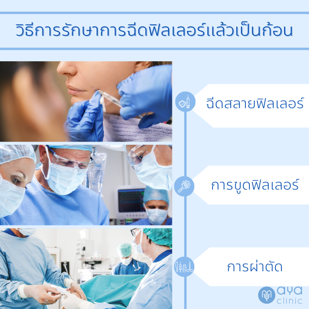 ฉีดฟิลเลอร์แล้วเป็นก้อน