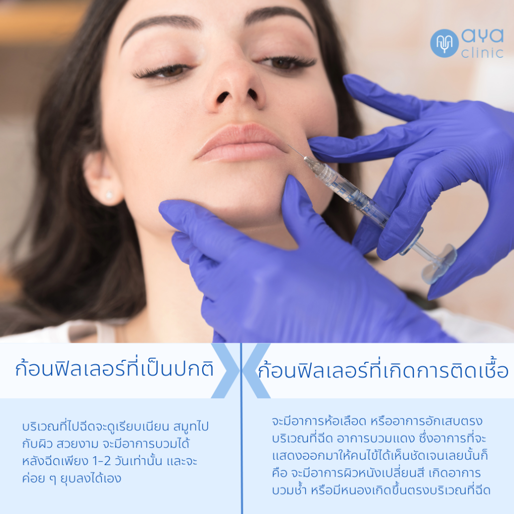 ฉีดฟิลเลอร์