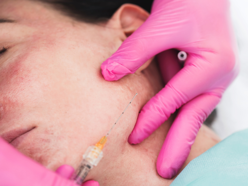 ฉีดฟิลเลอร์